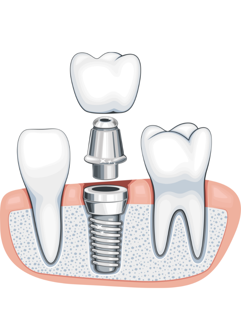 Dental Implant Marketing​